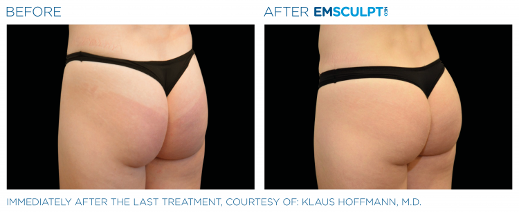 Before & After | EMSCULPT NEO | Body Contouring | Shahla Medical Group