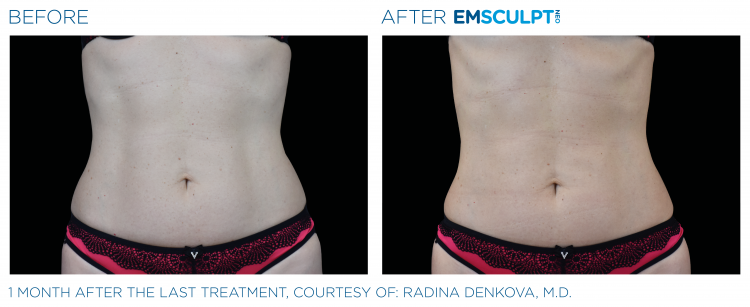 Before & After | EMSCULPT NEO | Body Contouring | Shahla Medical Group