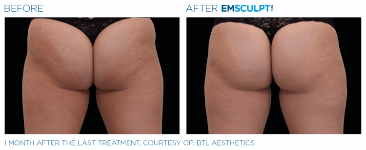 Before & After | EMSCULPT NEO | Body Contouring | Shahla Medical Group