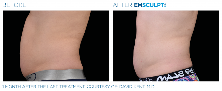 Before & After | EMSCULPT NEO | Body Contouring | Shahla Medical Group