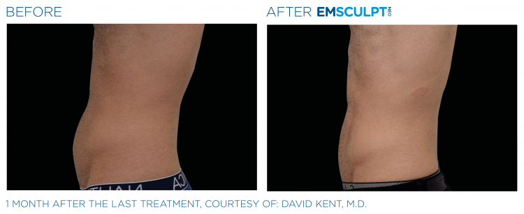 Before & After | EMSCULPT NEO | Body Contouring | Shahla Medical Group